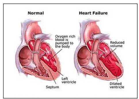 Apakah Gagal Jantung dan Serangan Jantung Berbeda? Simak Ini! 