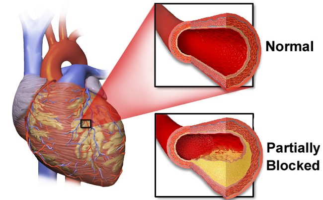 Apakah Gagal Jantung dan Serangan Jantung Berbeda? Simak Ini! 