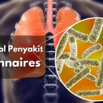 Apa Itu Penyakit Legionnaires? Gejala dan Pengobatannya